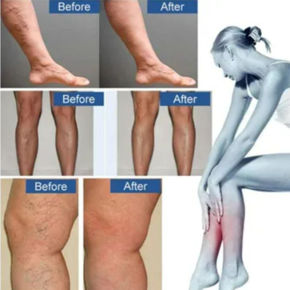 30 Parches de Varices para Circulacion